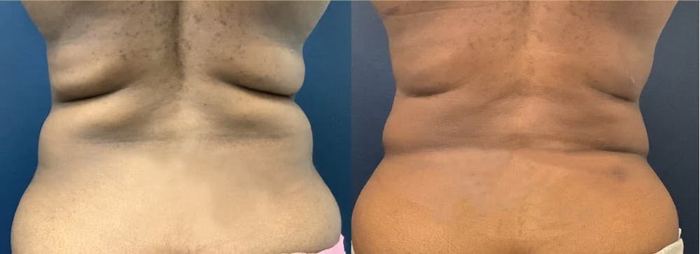 Liposuction Before & After Gallery - Patient 74784694 - Image 3
