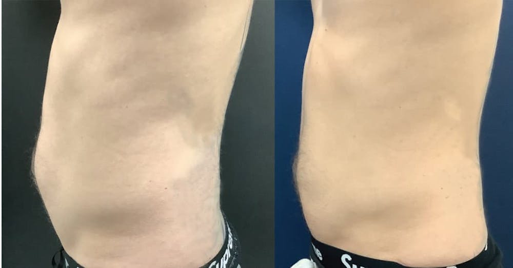 Liposuction Before & After Gallery - Patient 74784695 - Image 2