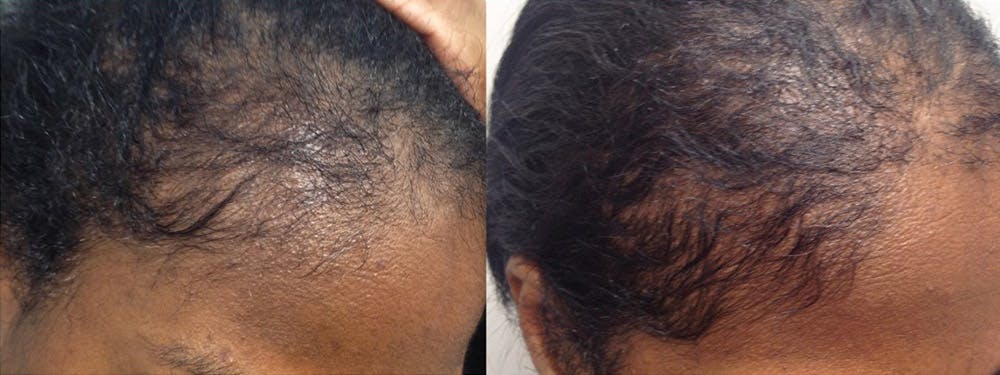 Hair Restoration Before & After Gallery - Patient 84797693 - Image 1