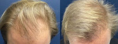 Hair Restoration Before & After Gallery - Patient 84797694 - Image 1