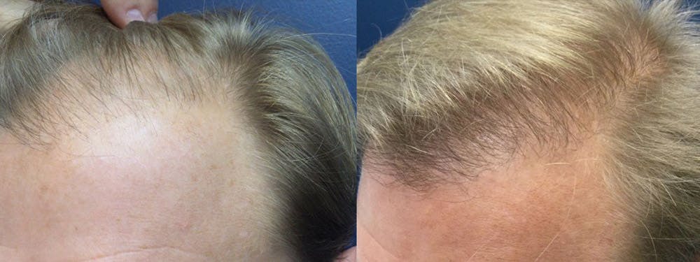 Hair Restoration Before & After Gallery - Patient 84797694 - Image 2