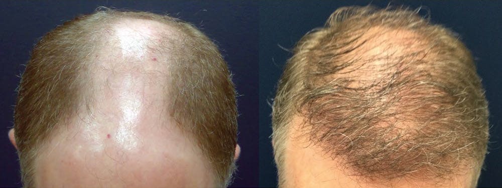 Hair Restoration Before & After Gallery - Patient 84797695 - Image 2