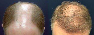 Hair Restoration Before & After Gallery - Patient 84797695 - Image 2