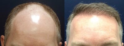 Hair Restoration Before & After Gallery - Patient 84797695 - Image 1