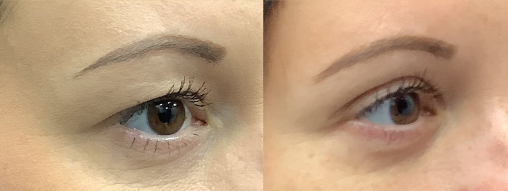 Eyelid Surgery Before & After Gallery - Patient 106048632 - Image 1