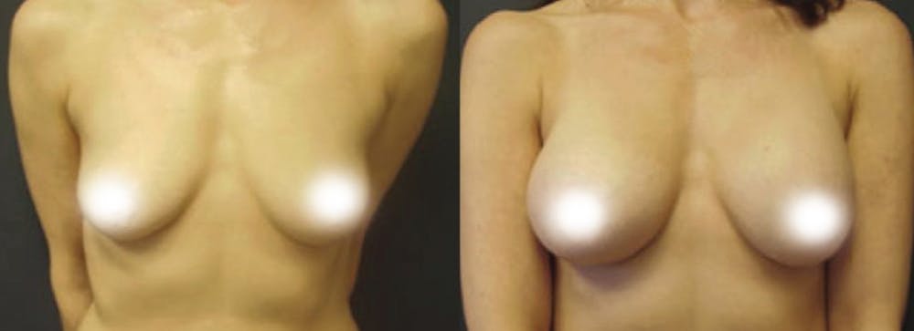 Breast Augmentation Before & After Gallery - Patient 106048636 - Image 1