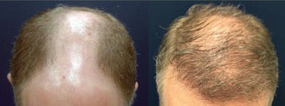 Hair Restoration Before & After Gallery - Patient 106306956 - Image 1