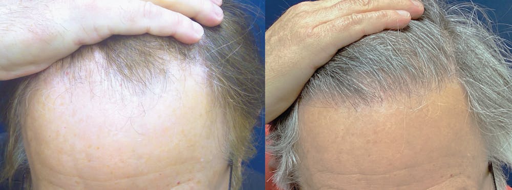 Hair Restoration Before & After Gallery - Patient 106306957 - Image 1