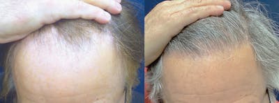 Hair Restoration Before & After Gallery - Patient 106306957 - Image 1