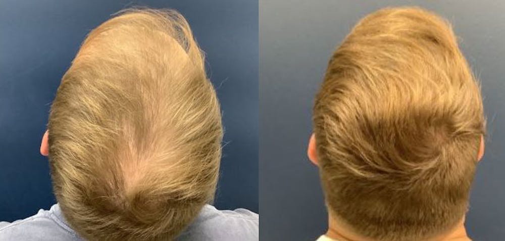 Hair Restoration Before & After Gallery - Patient 106306958 - Image 1
