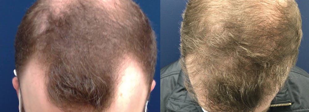 Hair Restoration Before & After Gallery - Patient 106306959 - Image 1