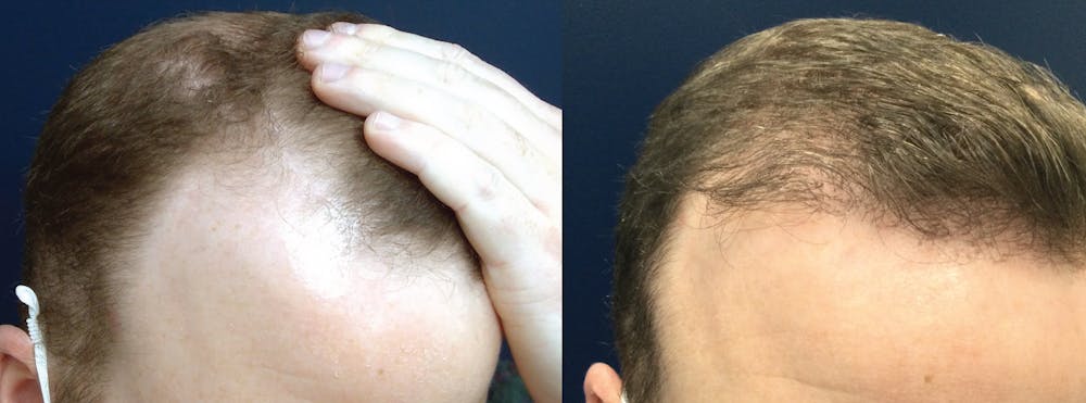 Hair Restoration Before & After Gallery - Patient 106306959 - Image 2