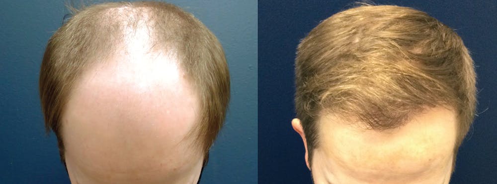 Hair Restoration Before & After Gallery - Patient 106306960 - Image 1
