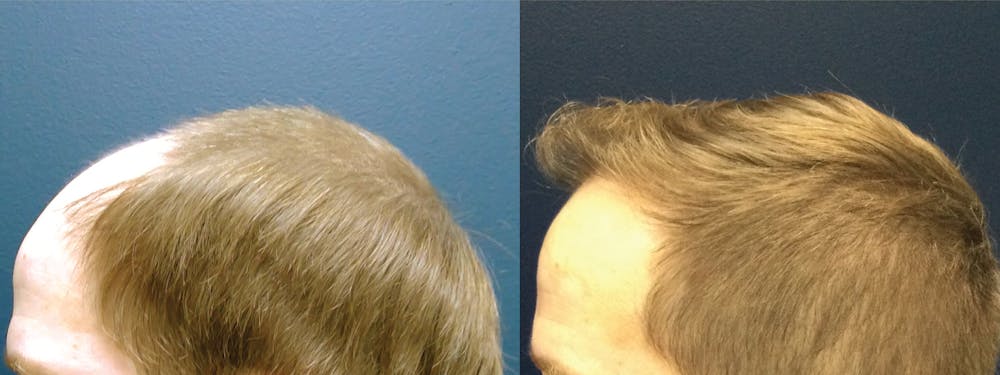 Hair Restoration Before & After Gallery - Patient 106306960 - Image 2