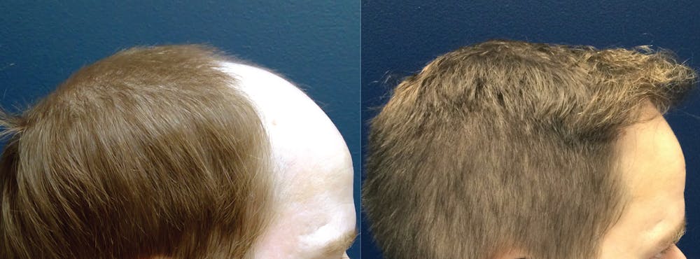 Hair Restoration Before & After Gallery - Patient 106306960 - Image 3