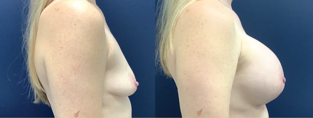Breast Augmentation Before & After Gallery - Patient 109018799 - Image 3