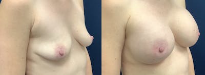 Breast Augmentation Before & After Gallery - Patient 109018799 - Image 2