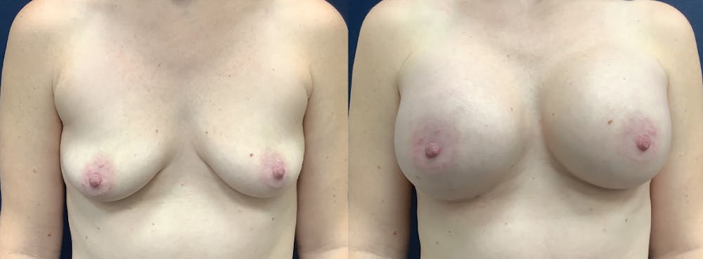 Breast Augmentation Before & After Gallery - Patient 109018799 - Image 1