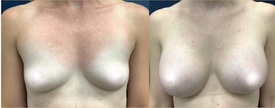 Breast Augmentation Before & After Gallery - Patient 116195332 - Image 1