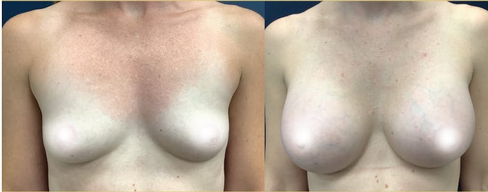 Breast Augmentation Before & After Gallery - Patient 116195332 - Image 1