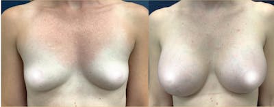 Breast Augmentation Gallery - Patient 116195332 - Image 1