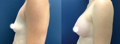 Breast Augmentation Before & After Gallery - Patient 116195332 - Image 2