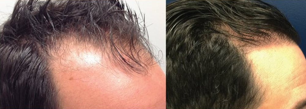 Hair Restoration Before & After Gallery - Patient 120421386 - Image 2