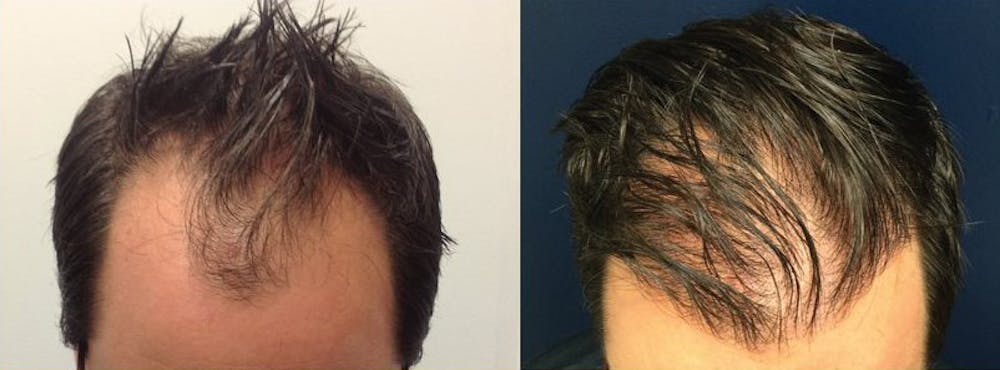 Hair Restoration Before & After Gallery - Patient 120421386 - Image 1
