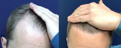 Hair Restoration Before & After Gallery - Patient 120421387 - Image 1