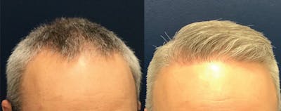 Hair Restoration Before & After Gallery - Patient 120421388 - Image 1