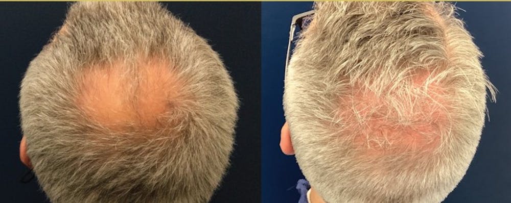 Hair Restoration Before & After Gallery - Patient 120421388 - Image 2