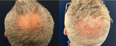 Hair Restoration Before & After Gallery - Patient 120421388 - Image 2