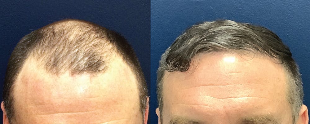 Hair Restoration Before & After Gallery - Patient 120421389 - Image 1