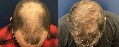 Hair Restoration Before & After Gallery - Patient 120421389 - Image 2