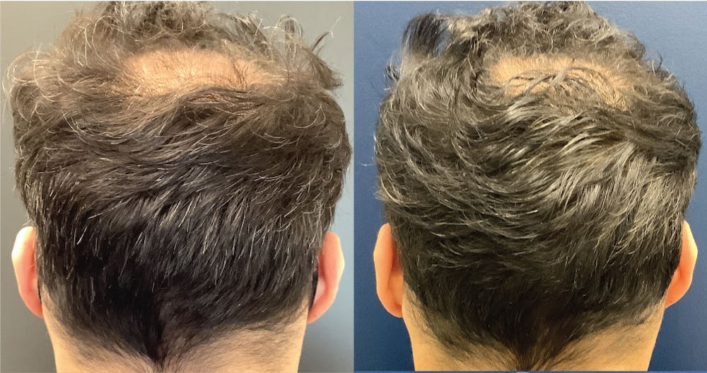 Hair Restoration Before & After Gallery - Patient 120773171 - Image 1