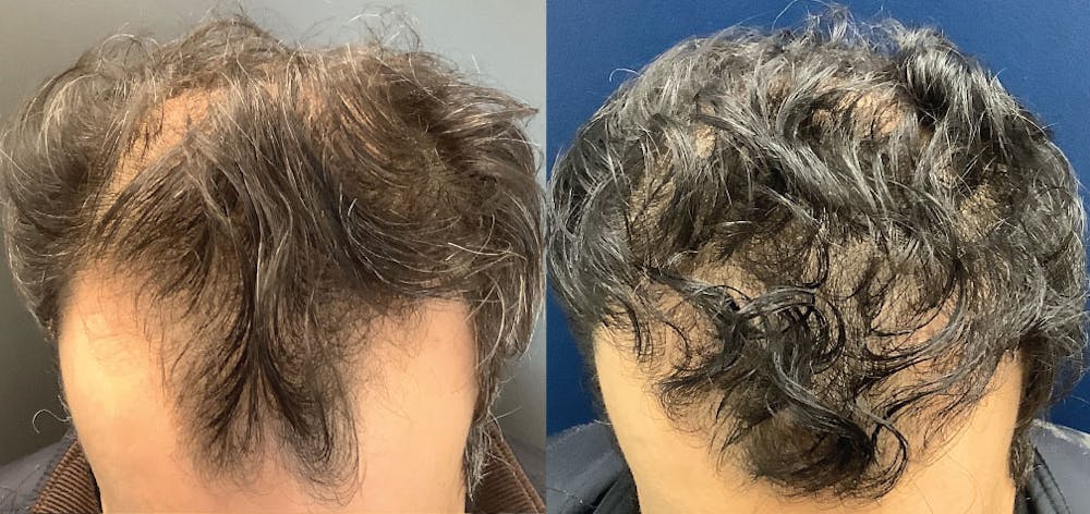 Hair Restoration Before & After Gallery - Patient 120773171 - Image 2