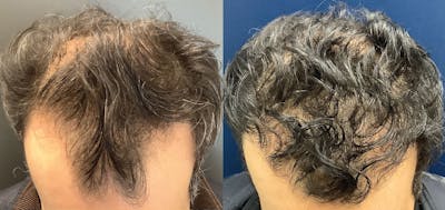 Hair Restoration Before & After Gallery - Patient 120773171 - Image 2