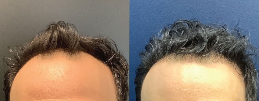 Hair Restoration Before & After Gallery - Patient 120773171 - Image 3