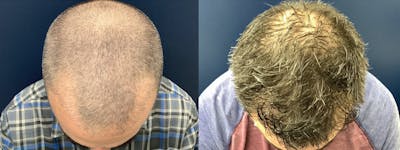 Hair Restoration Before & After Gallery - Patient 123023656 - Image 1