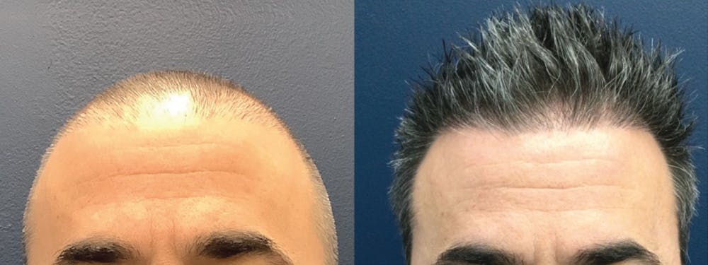 Hair Restoration Before & After Gallery - Patient 123023656 - Image 2