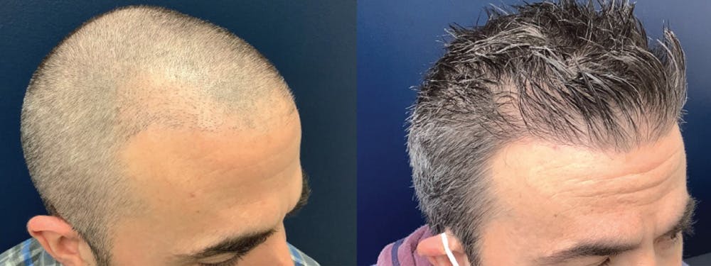 Hair Restoration Before & After Gallery - Patient 123023656 - Image 3