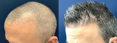 Hair Restoration Before & After Gallery - Patient 123023656 - Image 4