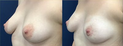 Areola Reduction Before & After Gallery - Patient 130598058 - Image 2