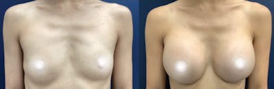 Breast Augmentation Before & After Gallery - Patient 141524929 - Image 1