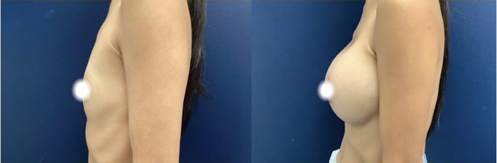 Breast Augmentation Before & After Gallery - Patient 141524929 - Image 2