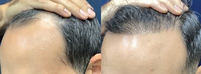 Hair Restoration Before & After Gallery - Patient 141524912 - Image 2