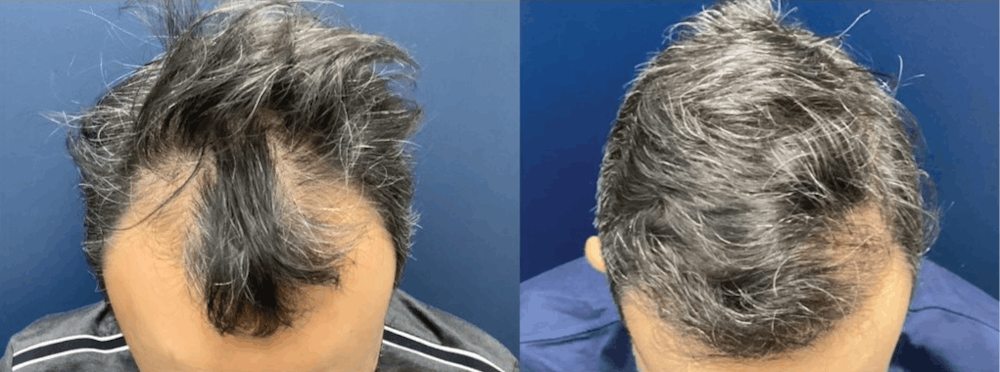 Hair Restoration Before & After Gallery - Patient 141524912 - Image 1