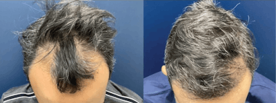 Hair Restoration Before & After Gallery - Patient 141524912 - Image 1