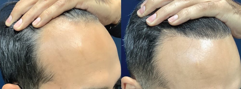 Hair Restoration Before & After Gallery - Patient 141524912 - Image 3