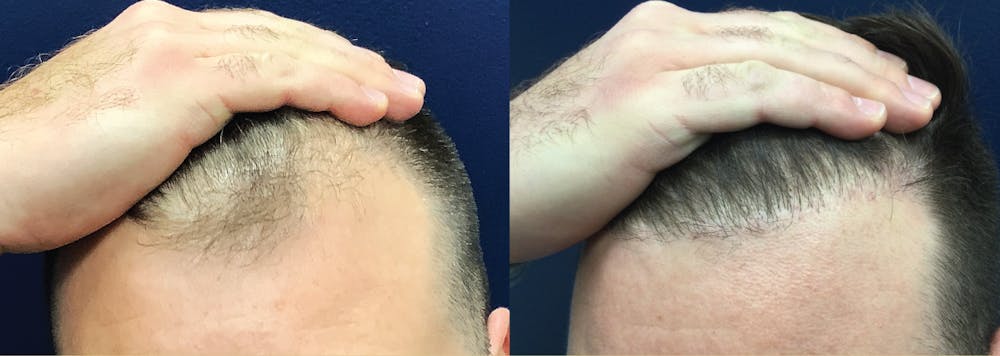 Hair Restoration Before & After Gallery - Patient 144174638 - Image 1